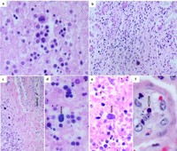 Pathologic Manifestations in a Case of Intrauterine Fetal Demise due to Parvovirus B19 Infection