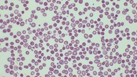 Hemoglobin C disease