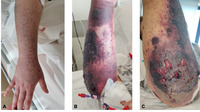 Drug-related akin toxicity or infections: a dramatic denudement in treated AML