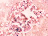 Figure d. Bone marrow aspirate smear 10X Perl’s stain showing multiple cells taking up the iron stain.