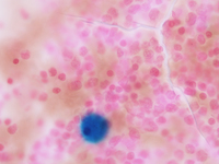 Figure e. Bone marrow aspirate smear 40X Perl’s stain showing Gaucher like cell taking up the iron stain.
