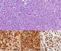 Histiocytic Sarcoma