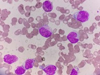 Peripheral smear showing Blasts and monocytoid cells