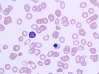 Figure 1. Peripheral smear 100X, Leishman stain showing cytopenias with presence of Nucleated RBC.