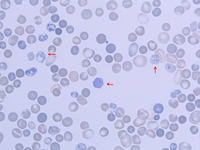 Figure 2. Peripheral smear 100X, Supravital (New Methylene Blue) Stain showing golf ball like inclusions (HbH inclusions)