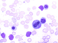 Figure 4. Bone marrow aspirate smear 100X, Giemsa stain showing Dysplastic Erythroid precursors