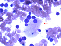 Figure 5. Bone marrow aspirate smear 100X, Giemsa stain showing Dysplastic Megakaryocyte