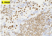 PAX8 IHC stain