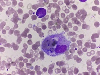 Hemophagocytosis