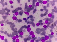 Imprint smear showing blast like lymphoid  cells with prominent nucleloli