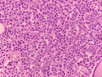 Bone marrow biopsy-infiltration by large lymphoid  cells with prominent eosinophilic nucleoli