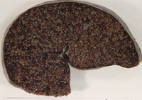 Splenic marginal zone lymphoma