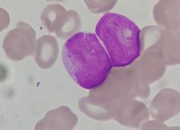 AML with cup shaped blats