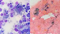 Hemophagocytosis and increased bone marrow iron stores