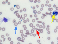 Sickle Cell Anemia