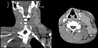 T-Lymphoblastic Lymphoma CT scan