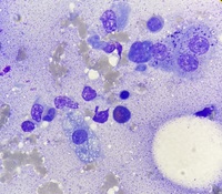 Metastatic gastric cancer cells 1