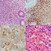 Atypical Appearing Crystals in Crystal-Storing Histiocytosis with Low-Grade B-Cell Lymphoma