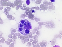 Hemophagocytic Lymphohistiocytosis 1