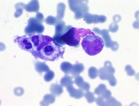 Hemophagocytic Lymphohistiocytosis 3