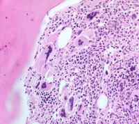 Para trabecular megakaryocyte clustering