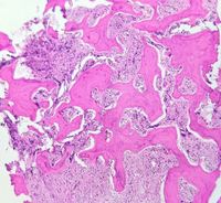 Osteosclerosis in PMF 1