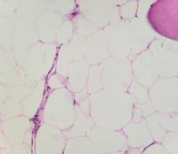 Aplastic marrow