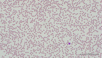 Drug-induced acanthocytosis 1