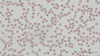 Drug-induced acanthocytosis 3