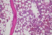 Panel A, 10X: Focal area of epithelioid cells in bone marrow core biopsy