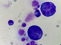 infiltrated plasma cell in pleural fluid 2