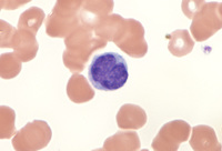 Waldenstrom's macroglobulinemia-PB 2