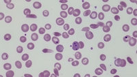 Sickle cell anemia with functional hyposplenism 1