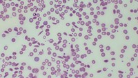 Sickle cell anemia with functional hyposplenism 2