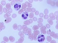 Chediak-Higashi syndrome - Neutrophils