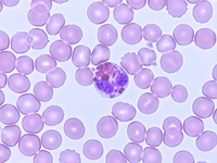 Chediak-Higashi syndrome - Eosinophil