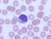 Chediak-Higashi syndrome- Lymphocyte