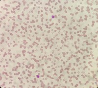 Peripheral smear