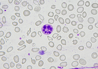 Botryoid neutrophil