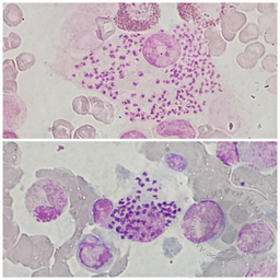 Leishmaniasis