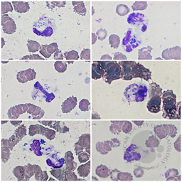Phagocyting neutrophils in peripheral blood