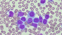 Prolymphocytic progression of CLL