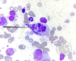 Botryoid neutrophil - In a case of scrub typhus