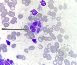 Botryoid neutrophil - In a scrub typhus case