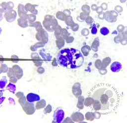 Reactive vacuoles in Botryoid neutrophil
