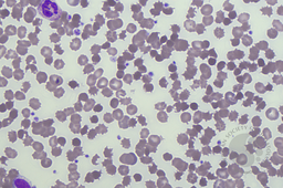Alectinib Induced Haemolytic Anaemia