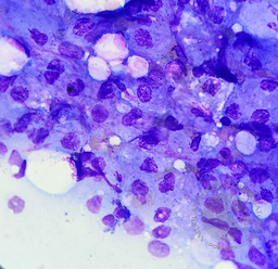 Gaucher cell disease 4