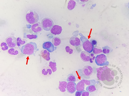Follicular lymphoma cells in bone marrow