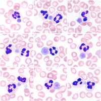 Platelet satellitism in immune thrombocytopenic purpura