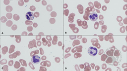 Green neutrophilic and monocytic inclusions as a dire prognostic indicator for clinical outcome.